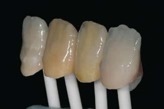 Figure 6: The body colors were tested and the dentin porcelain was cut