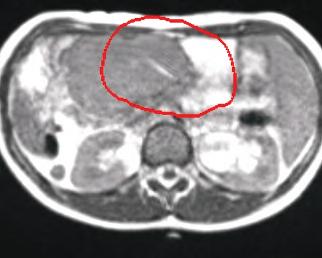 MESENTERY Intra-abdominal Mesenteric Desmoid Tumor Ms. N.