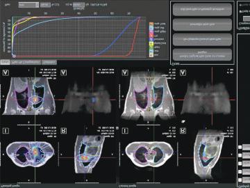 Auto-Contour ADAPT Auto-Contour MRIdian provides real-time imaging that clearly defines the targeted tumor from the surrounding soft tissue and other critical organs.