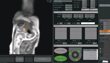 Track Tissue and Verify Target TRACK Track Tissue and Manage Patient Motion MRIdian captures multiple soft-tissue imaging planes concurrently during treatment, refreshing the image multiple times per