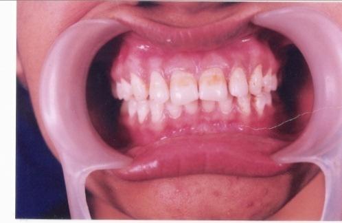 With this product also negative changes were evident, as with VivaStyle Paint On. This may be the result of subjective assessment of tooth colour.