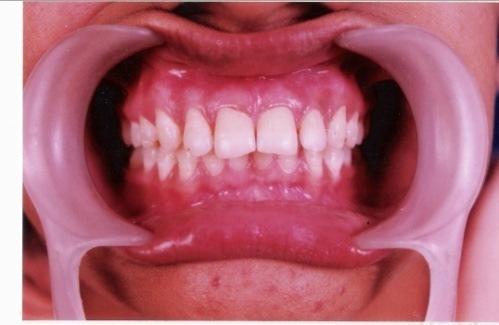 the Gingival Index scores remained the same as like the preoperative score.the severity of sensitivity decreased with time.