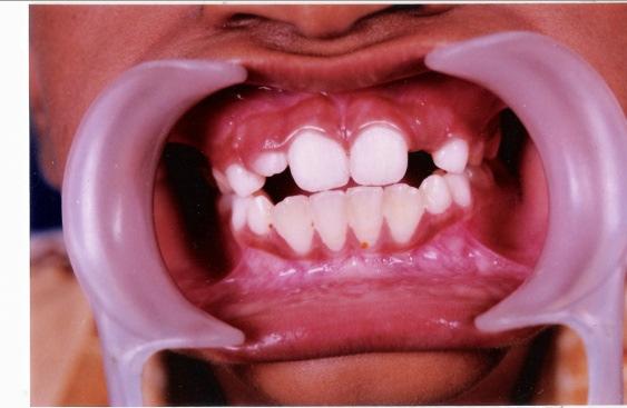 Evidence of mild gingival inflammation was found in one subject in group I and two subjects in group II.