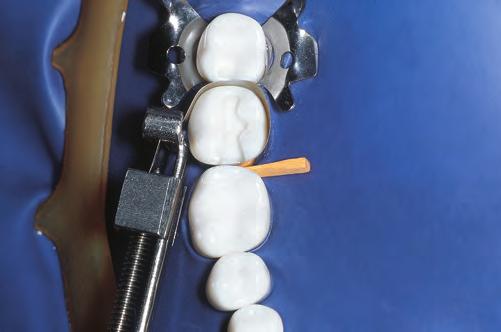 Restorative dentistry is indicated when teeth are to be restored to their original structure with the use of direct and indirect restorative dental materials.