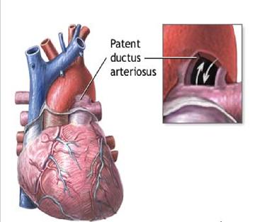 Patent Ductus Arteriosus If the ductus arteriosus remains open after birth and fails to close it is referred to as a patent ductus arteriosus. The term patent means open.