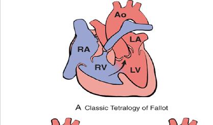 Right-to-Left Shunts Cardiac malformations associated with right-toleft shunts are distinguished by