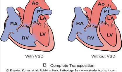 disease). A, Tetralogy of Fallot. B, Transposition of the great vessels with and without VSD.