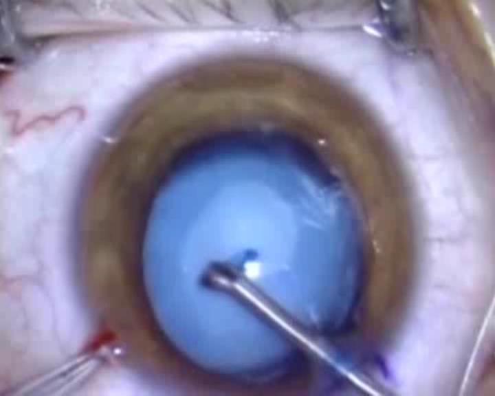Surgical steps Incision: small / suture Anterior capsule: capsulotomy / vitrectorexis / CCC Lens: aspiration / lensectomy, no hydrodelineation - no phaco, multi- hydrodissection, PI Posterior