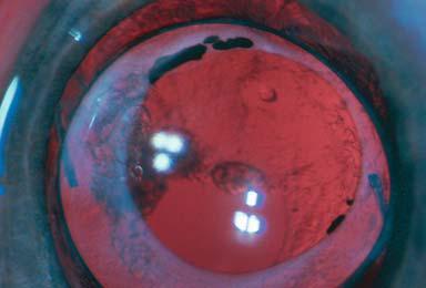 - Amblyopia - Glaucoma (30%) - Retinal