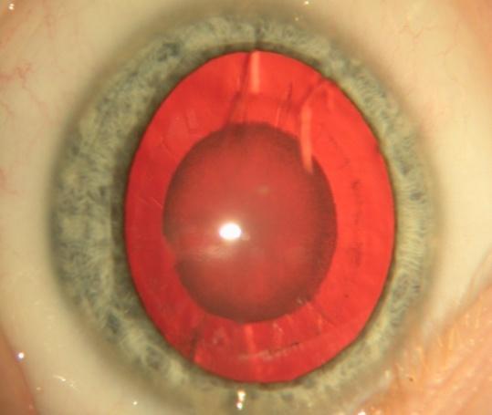 Cataract morphology