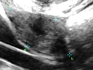 Low antral follicle count (Ovarian Reserve) Good antral follicle count (Ovarian Reserve) Vaginal Ultrasound: in expert hands (a reproductive endocrinologist), it is an accurate measure for