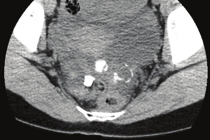 Figure 2: Laparoscopy showing normal ovaries (arrows) and a multilobular tumor in Douglas pouch (arrow head). hyalinization (Figure 4).