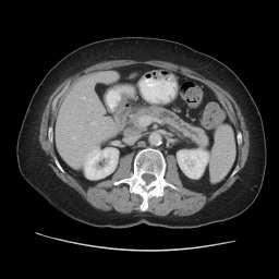 SECTION HEADING Pancreatic Head Mass Differential diagnosis Cameron et al. Ann Surg 2006 Multidetector CT scan Water as oral contrast < 1.