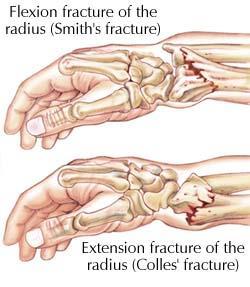 scaphoid links prox and distal rows Fx upon falling in ext/supination (backward onto hand) (+) axial compression of thumb vs scaphoid (+) Scaphoid shift/watson test Thumb