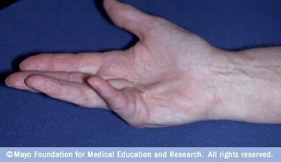 tissue in palmar/digital fascia of hand Flexion contracture