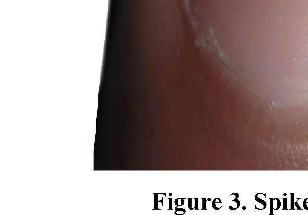 parasternal diastolic murmur associated with dyspnoea in aortic IE.