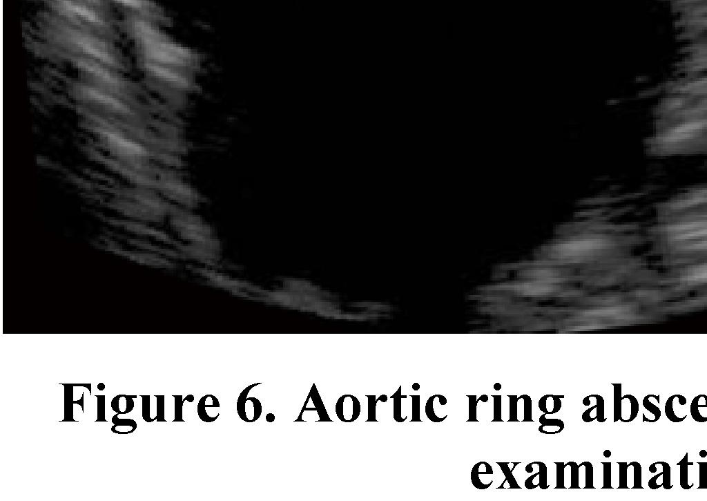 Generally, sensitivity of transthoracic echocardiography is around 60%, and its specificity for vegetations is around 90% [6, 7].