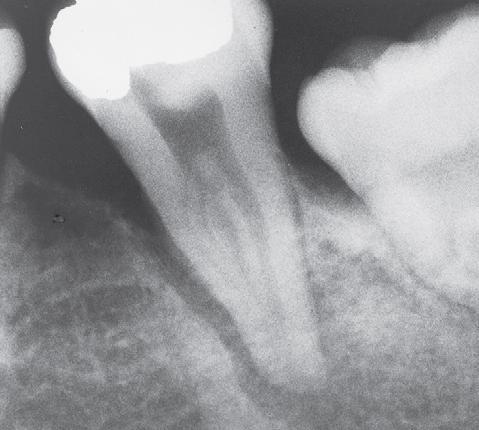 This is a radiograph for a very mobile tooth due to severe periodontal disease with bone loss and wide periodontal ligament space, easy to extract