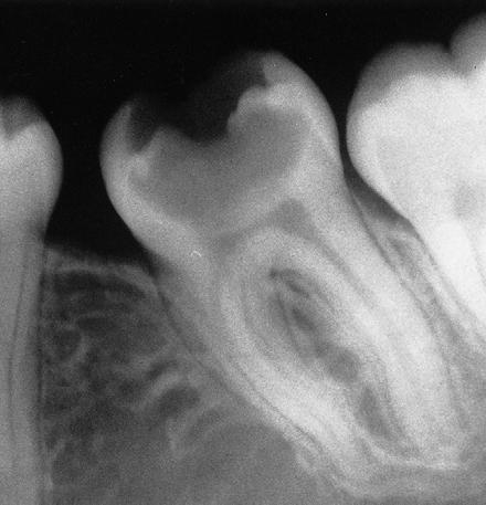 making extraction easier) A radiograph for a big crown with very large caries, this crown is susceptible to fracture once we use forceps and apply force.