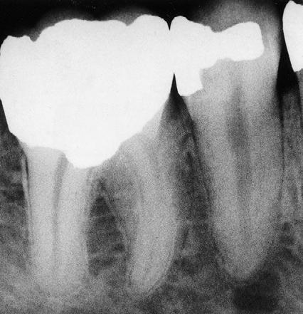 **There was a radiograph for periapical lesion, you should do percussion test for the tooth, if the pain resulted was acute don t apply extraction, give