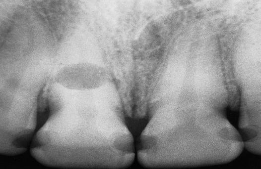 A radiograph for a tooth with internal resorption, this tooth is susceptible to fracture at the resorption area which makes closed extraction almost impossible.