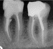 the teeth structures would be in adherent to bone so extraction would be so hard, so most of these cases should be referred to surgery.