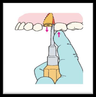 The forceps grip is below the CEJ, all the forces distribute along the long access of the tooth. We apply dilatation for the bony socket to release the root using gentle forces.