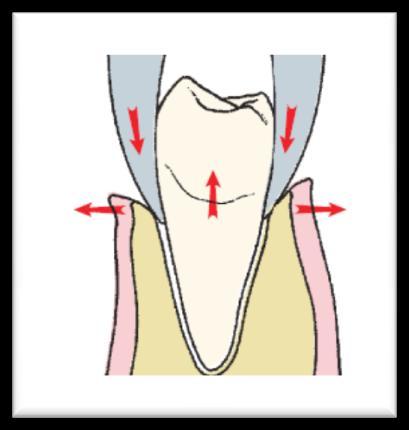 Rotational movement, this is best applied when the tooth root is conical like the central incisors and the lower teeth. 5. Tractional force (tooth delivery).