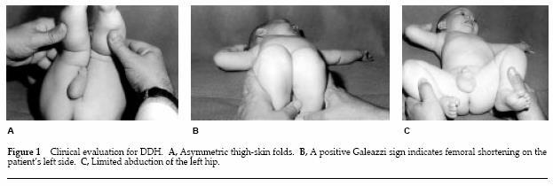 Clinical Signs Assymmetric skin folds: not always reliable Hip abduction can be close to