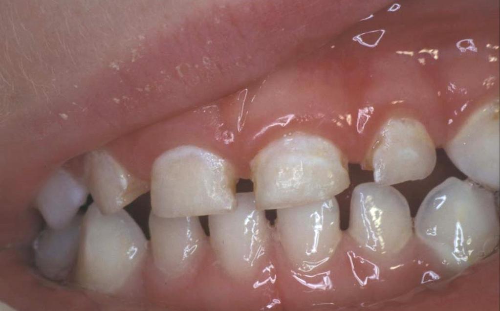 2 First clinical signs of caries First clinical signs of caries White spots Acids have demineralized enamel First appear at gumline of upper front teeth High risk for developing cavities White spots