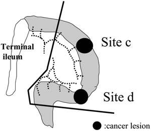 (-),stage Ib Fig.2 Preoperativebarium enemastudy Sitec:tumorofthetransversecolon(thirdcolonic lesion) Sited:tumorofthesigmoidcolon(fourthcolonic lesion) technique.
