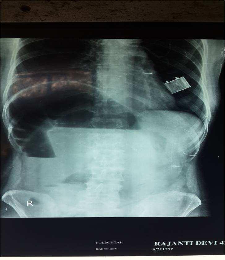 191 FIGURES 192 193 194 195 Figure 1:X-Ray abdomen showing dilated colon lying