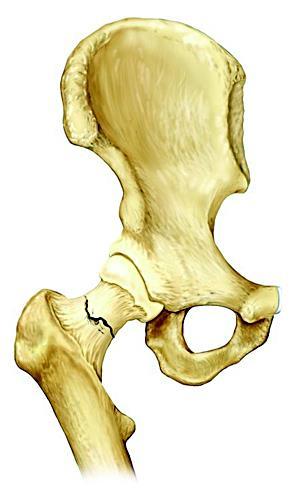 Low trauma fracture, low bone mineral Density 1.