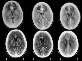 Review time, patients with malignant glioma were enrolled into separate trials for anaplastic astrocytoma (WHO grade III) or glioblastoma multiforme (WHO grade IV).