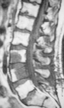 Epidemiology of Spine Metastases Spine = most common site of metastatic disease to bone 5-10% of cancer pts (autopsy up to 70%) breast ca: