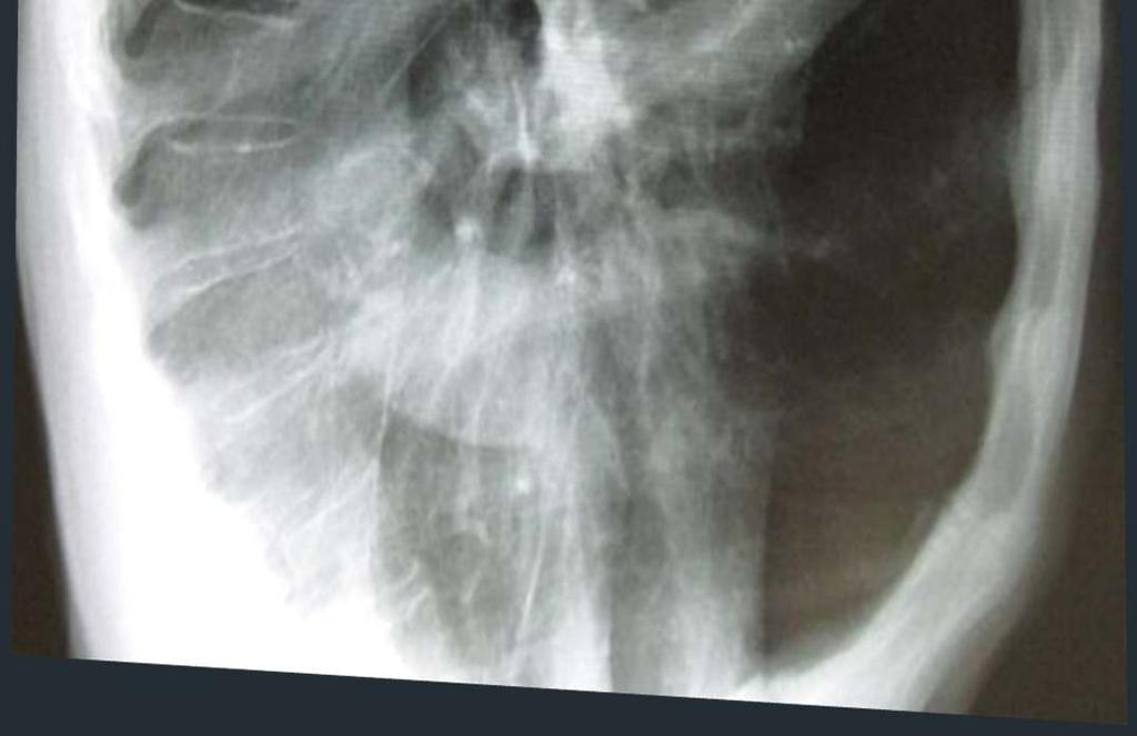 Chest X-ray A lateral