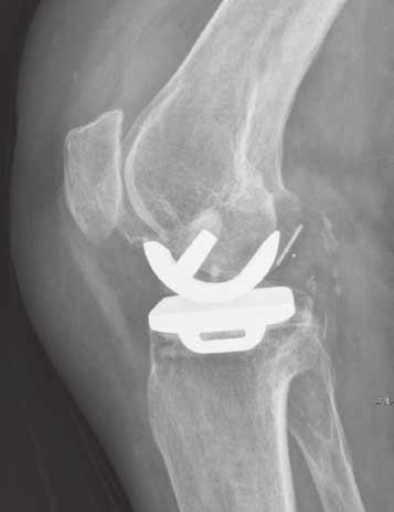 338 q. zhang, w. guo, z. liu, l. cheng, d. yue, n. zhang Fig. 5. Posterior dislocation of the bearing in OA group postoperative results were comparable in terms of pain and knee score.
