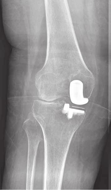 Minimally invasive UKA is an effective method for spontaneous osteonecrosis of the knee. The medium-term outcome of UKA in SONK is encouraging.