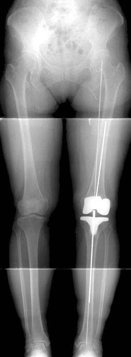 10 Nam et al. A Comparison of Results of Mobile Bearing Total Knee Arthroplasty arthroplasty was observed in 1 case (Fig. 1) and painful patella crepitus was observed in 2 cases (8.3%).