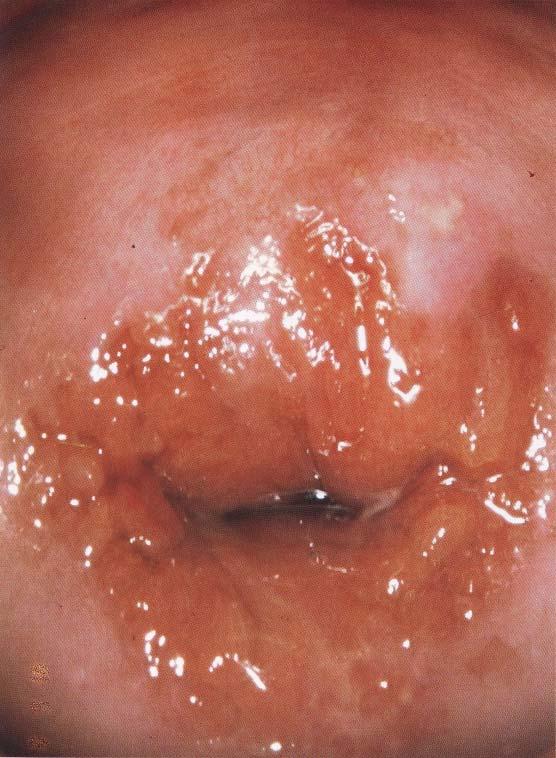 Colposcopy- Cervical Pathology, 1998.