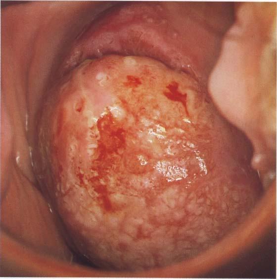 Slika 13, Kolposkopska slika invazivnog karcinoma ( Burghart E.