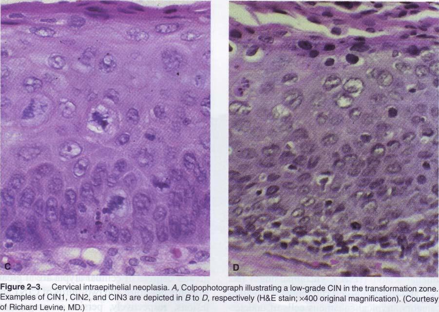 Teška displazija, CIN 3, podrazumjeva izražen poremećaj slojevitosti, celularnu atipiju, izraženu jedarnu hiperhromaziju, patološke mitoze, dok jedan ili dva sloja ćelija na površini ne moraju biti