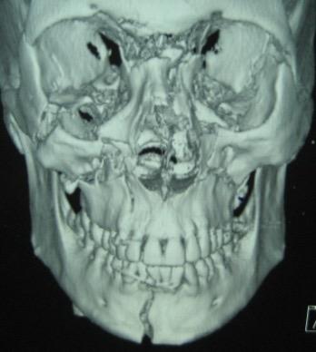 Slika 6. 3D prikaz kostiju lica s frakturom mandibule u području simfize. Preuzeto: (12). 9. VRSTE LIJEČENJA PRIJELOMA DONJE ČELJUSTI 9.1. VRSTE TERAPIJE Frakture mandibule liječe se na dva načina, zatvorenim i otvorenim (11).