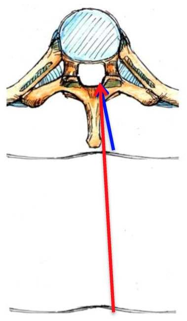 spinous process. In this technique, no or minimal medial angulation is required and the spinous process can be avoided along the needle trajectory (Figure 3).