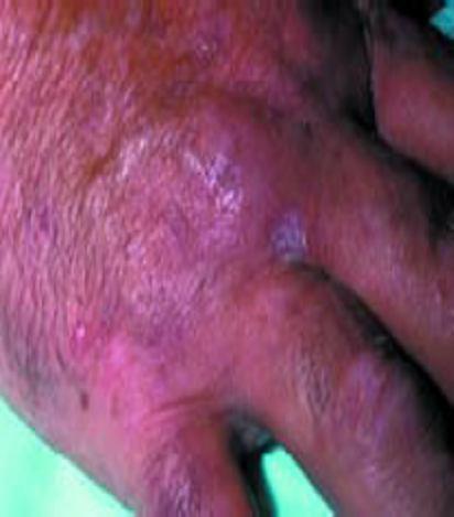 Lichen planus (LP) Is a recurrent pruritic eruption characterized by flat-topped violaceous papules that can develop on any skin site (arms, trunk, genitalia, nails and scalp), and mucosal membranes