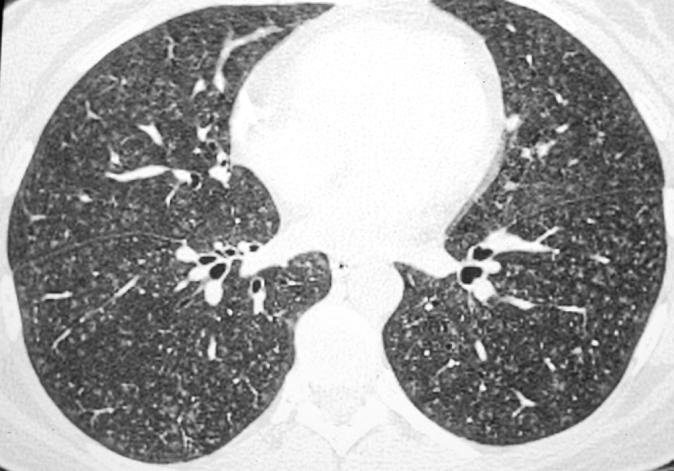 predominance Upper & Mid lung Nodules