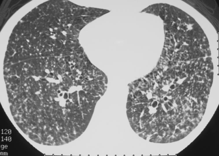 RB-Interstitial lung disease 4. Silicosis 5.