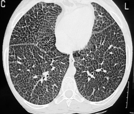 pneumonitis (chronic) Pulmonary edema ARDS Reticular