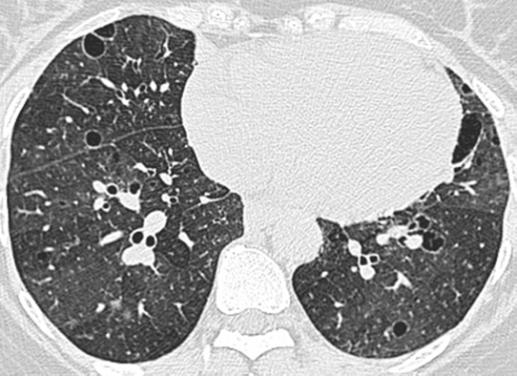 airspaces Defn:enlarged foci of air-containing lung