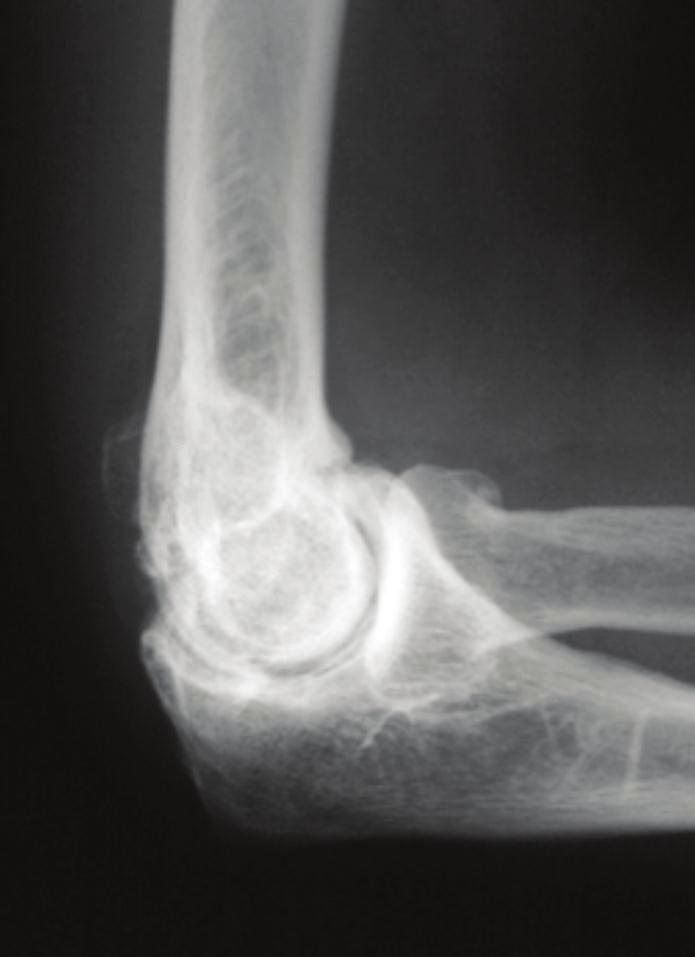 2 Arthritis Figure 1: Lateral radiograph demonstrates idiopathic arthritis with osteophytes on the radial head as well as anterior and posterior ulnohumeral joints.